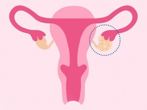 کیست تخمدان چیست