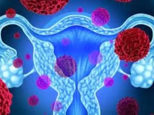 فریز زخم دهانه رحم