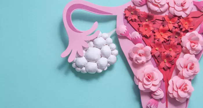 درمان کیست تخمدان با روش لاپاراسکوپی