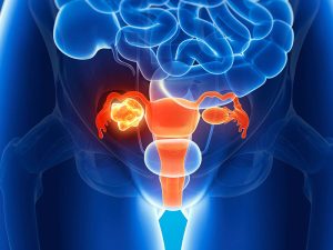 علائم سرطان دهانه رحم چیست؟