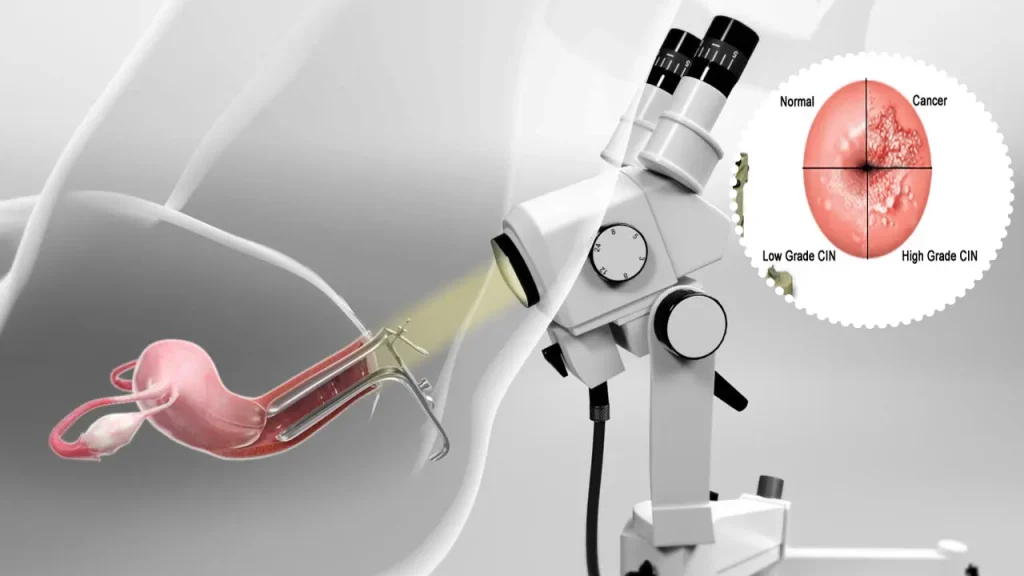 کولپوسکوپی