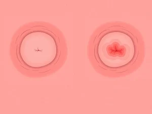 زخم دهانه رحم (سرویسیت)