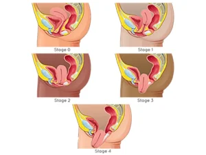 مراحل افتادگی رحم