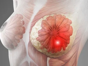 درد در سرطان سینه